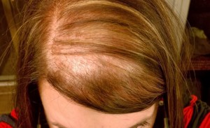 PKO saç dökülmesi tedavisi
